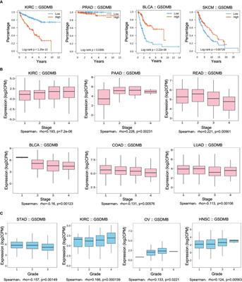 Systematic pan-cancer analysis identifies gasdermin B as an immunological and prognostic biomarker for kidney renal clear cell carcinoma